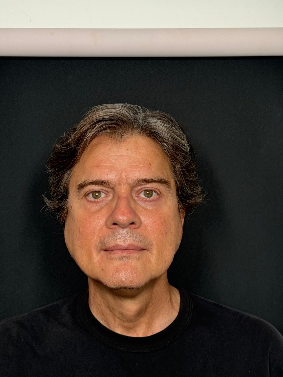 Antes blefaroplastia caso 3